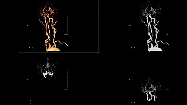 脑部CTA包括颈部三维体积渲染图像在屏幕上显示颈总动脉。医疗技术的概念。视频素材
