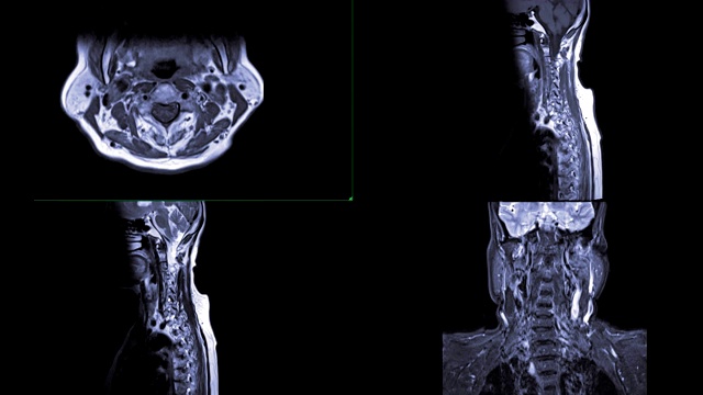 颈椎MRI C-spine或MRI图像轴向、冠状面和矢状面显示脊椎病和压缩性骨折。视频素材