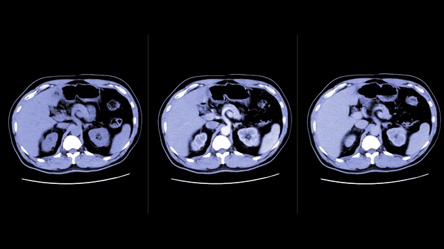 非造影剂对比，A期、V期及延迟期轴位显示主动脉强化，可诊断腹部疾病及肿瘤。视频素材