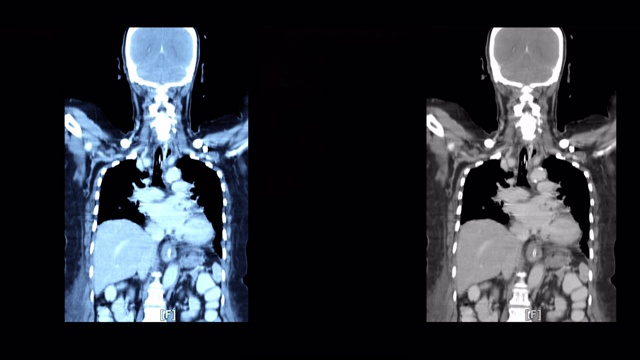 身体前方x射线图像视频素材
