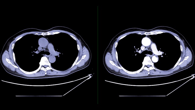 对比CT胸部与对比剂或CTA肺动脉注射造影剂后诊断肺栓塞和肺部疾病视频素材