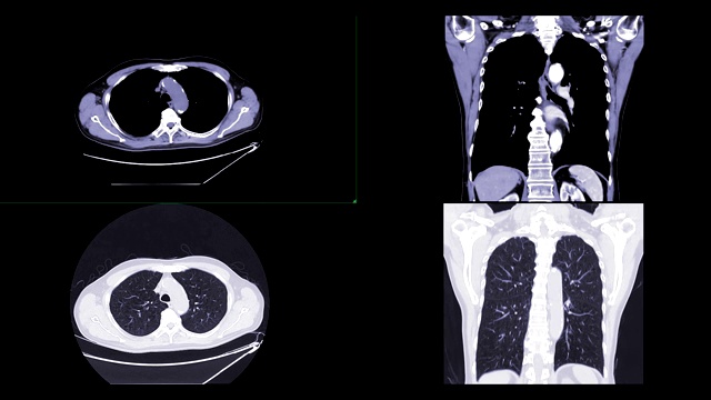 CT胸部多视图对比剂或CTA肺动脉注射造影剂后诊断肺栓塞和肺部疾病。视频素材