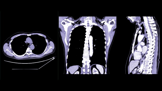 CT胸部造影剂或CTA肺动脉轴向NC，冠状面和矢状面诊断肺栓塞和肺部疾病。视频素材