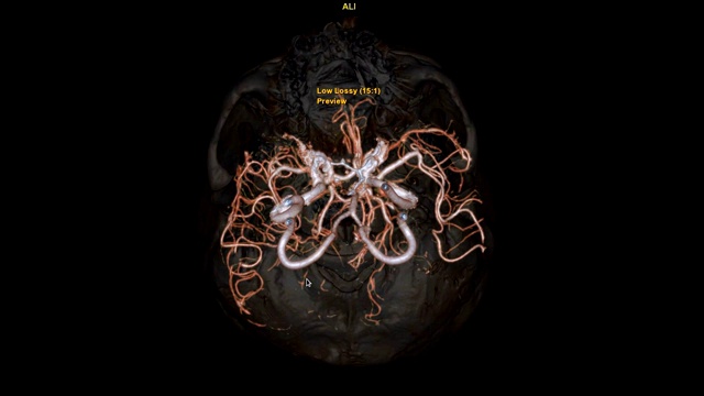 脑部CTA或脑部ct血管造影(computed tomography angiography of the Brain)三维显示脑部动脉和透明骨在屏幕上旋转的图像。视频素材