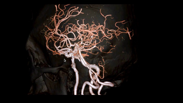 脑部CTA或脑部ct血管造影(computed tomography angiography of the Brain)三维显示脑部动脉和透明骨在屏幕上旋转的图像。视频素材