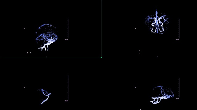 脑部CTA或脑部ct血管造影3D MIP显示大脑动脉。视频素材