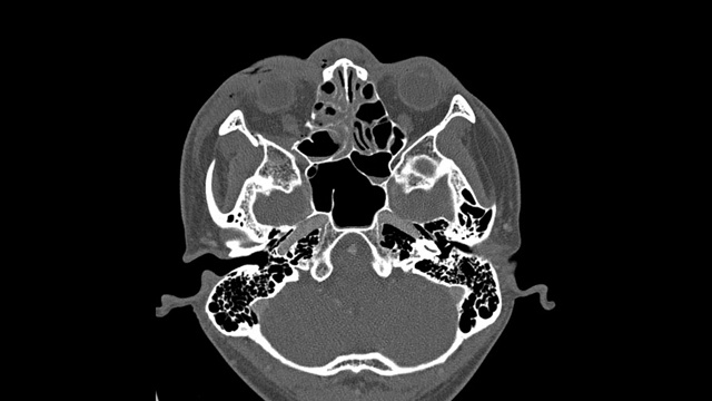 眼眶计算机断层扫描，男性，26岁交通事故移位骨折右眼眶外侧和内侧壁。医学图像。视频下载