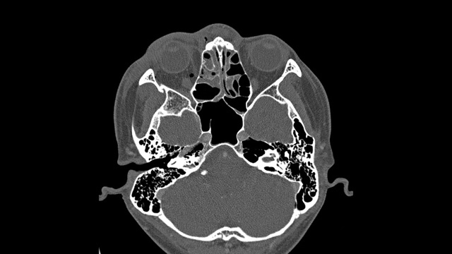 眼眶计算机断层扫描，男性，26岁交通事故移位骨折右眼眶外侧和内侧壁。医学图像。视频下载