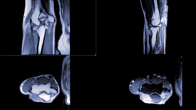 肘部MRI或肘部磁共振成像。视频素材