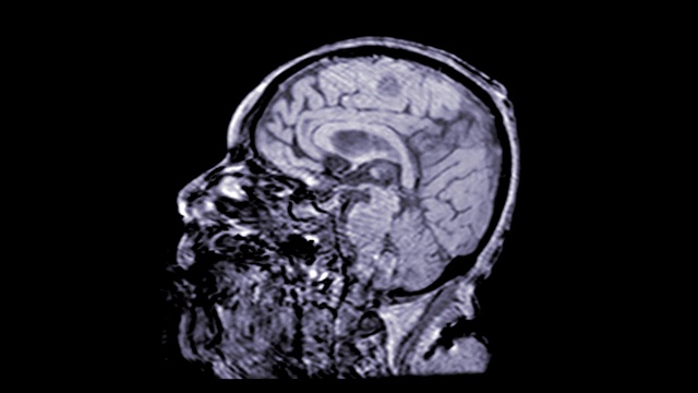 MRA大脑或磁共振血管造影的脑矢状面缓慢运动评估大脑和大脑动脉。视频素材