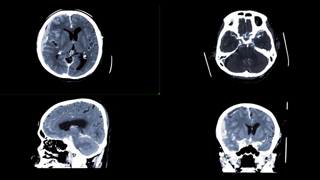 脑部CTA对比轴位、矢状面、冠状面显示脑硬膜下出血。视频素材