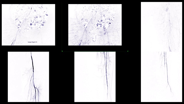 左股动脉的多视图血管造影显示白色背景上孤立的血管诊断动脉粥样硬化。视频素材