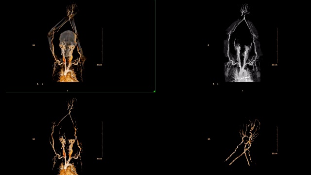 臂动脉CTA多视图或上肢CT扫描三维渲染图像诊断臂动脉狭窄。视频素材