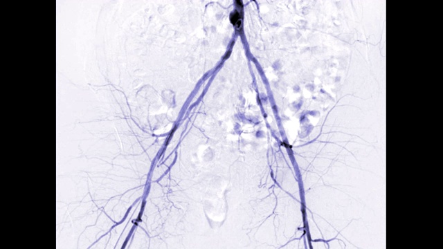 股动脉血管造影显示白色背景上孤立的血管以诊断动脉粥样硬化。视频素材
