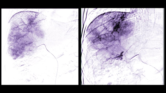 TOCE或化疗栓塞是一种程序，允许化疗药物直接给药给肿瘤。视频素材