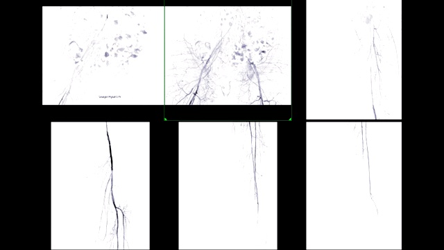 左股动脉的多视图血管造影显示白色背景上孤立的血管诊断动脉粥样硬化。视频素材