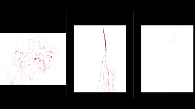 左股动脉的多视图血管造影显示白色背景上孤立的血管诊断动脉粥样硬化。视频素材