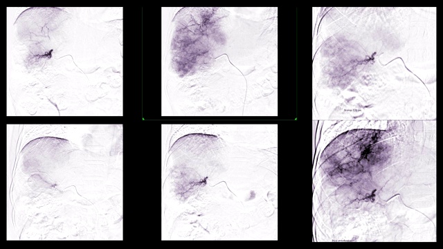 TOCE或经导管含油化疗栓塞术是一种可以直接给药给药的手术。视频素材