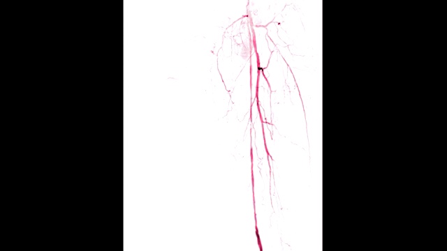 左股动脉血管造影显示白色背景上孤立的血管，诊断动脉粥样硬化。视频素材