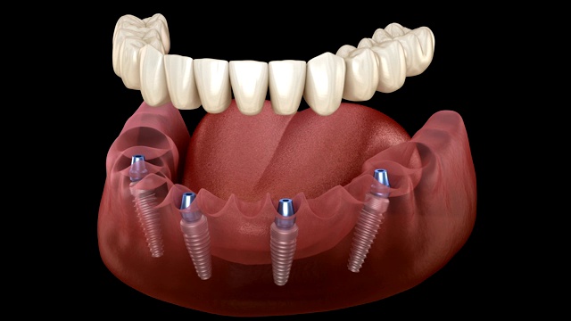 下颌假体4个系统，种植体支持。医学上精确的人类牙齿和假牙的三维动画概念视频素材