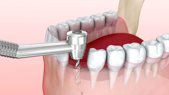种植牙安装流程，医学精准3d动画视频素材
