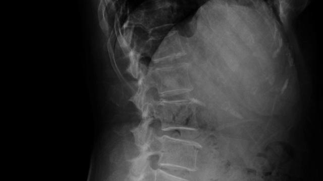 l-脊柱退行性改变侧位图视频素材