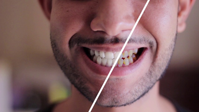 微笑男子前后牙齿美白程序视频素材