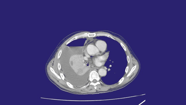 胸部计算机断层扫描。医学背景视频下载