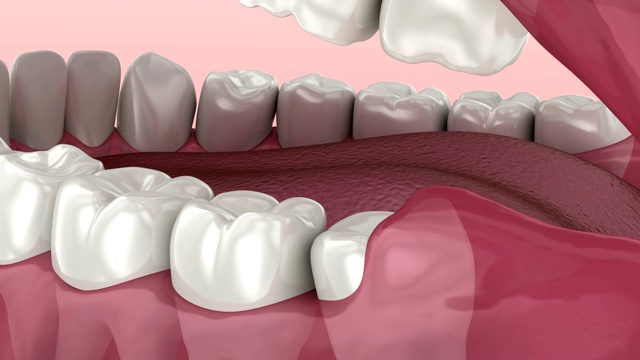 智齿的问题。医学上准确的牙齿3D动画视频素材