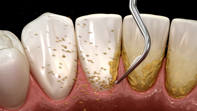 口腔卫生:超声波洁牙机，清除牙石和牙菌斑。医学上精确的人类牙齿治疗的3D插图视频素材