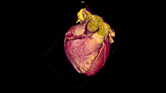CTA冠状动脉三维渲染图像在屏幕上旋转，用于发现心血管疾病。视频素材