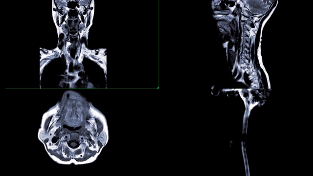 颈椎冠状面、矢状面、轴向面及矢状面MRI脊髓造影诊断脊髓压迫。视频素材