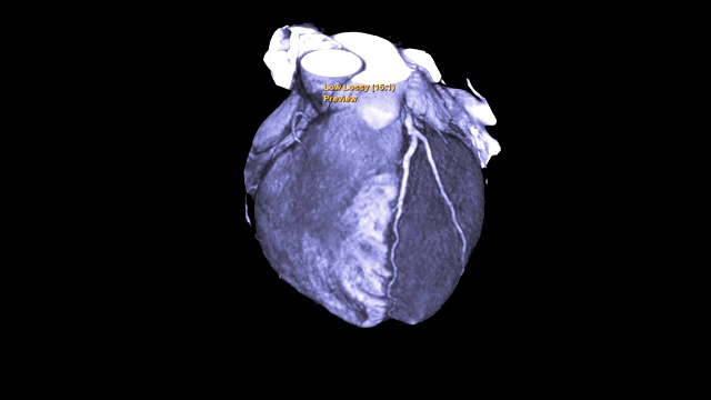 CTA冠脉三维渲染图像或冠脉树在屏幕上旋转，用于诊断冠脉狭窄的血管。视频素材