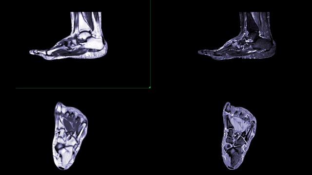 MRI FOOT比较矢状和轴向T2、T1诊断肌腱损伤。视频素材