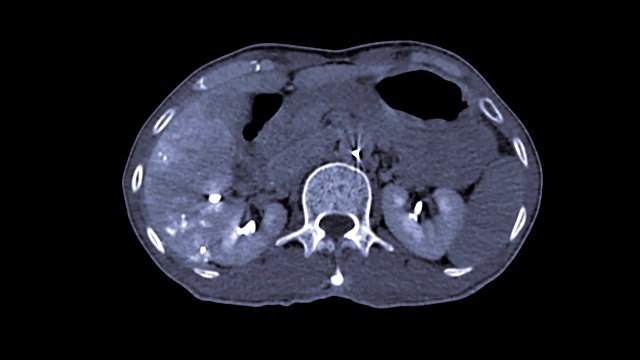 TOCE或化疗栓塞后CT上腹部造影剂。视频素材