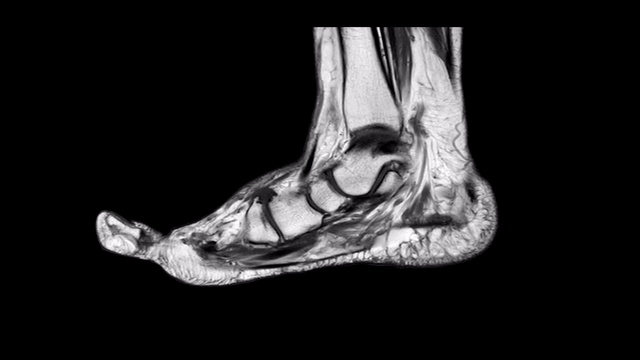MRI足矢状T2诊断肌腱损伤。视频素材