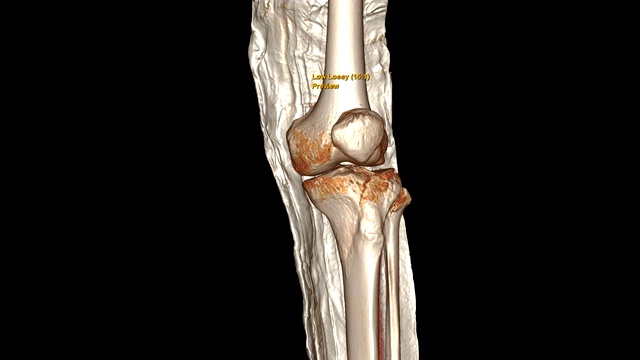 带长腿板的CT膝关节3D渲染图像显示胫骨骨折。视频素材