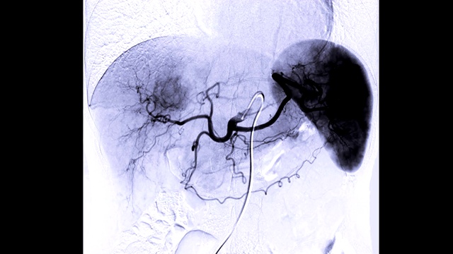 TOCE或化疗栓塞是一种程序，允许化疗药物直接给药给肝肿瘤或肝癌。视频素材