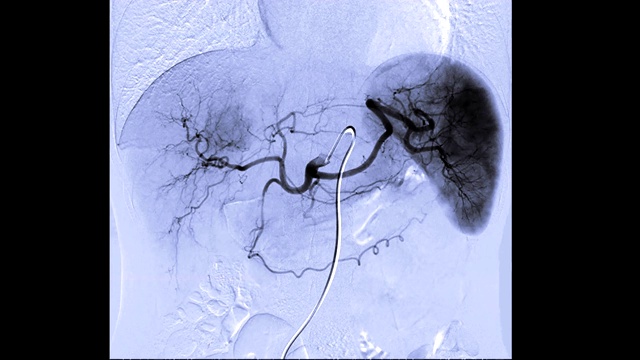 TOCE或化疗栓塞是一种程序，允许化疗药物直接给药给肝肿瘤或肝癌。视频素材