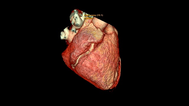 CTA冠状动脉三维渲染图像在屏幕上旋转，用于发现心血管疾病。视频素材