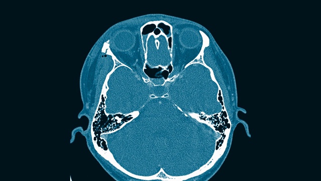 CT扫描大脑和眼眶视频下载