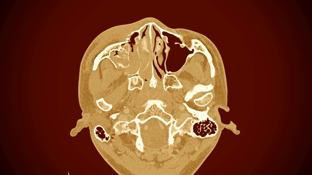 右眼眶外侧壁及内侧壁移位性骨折之CT扫描。视频素材