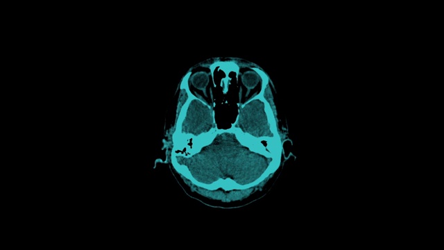 蓝色调的CT脑动画视频素材