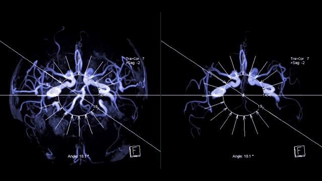 脑或磁共振血管造影(MRA)的血管在屏幕上转动。MRA脑MIP视图评估大脑动脉。视频素材