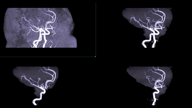 脑或磁共振血管造影(MRA)的血管在屏幕上转动。MRA脑MIP视图评估大脑动脉。视频素材