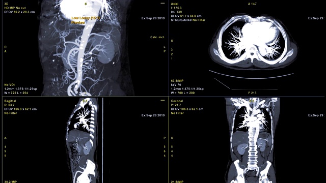 CTA全主动脉三维渲染图像与轴面、冠状面、矢状面对比。视频素材