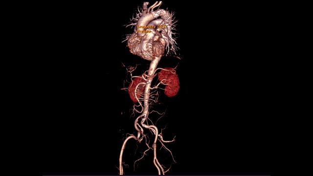CTA全主动脉三维渲染图像在屏幕上旋转，用于检测动脉瘤。视频素材