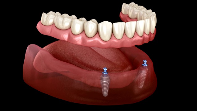 下颌可移动假体全部在2个系统支持种植体与球附件。医学精确牙科3D动画。视频素材
