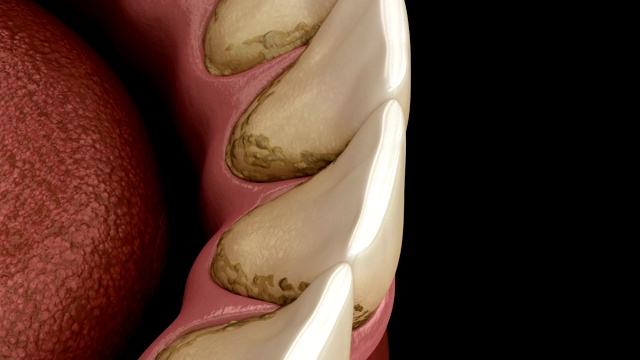 牙垢和牙菌斑，下颚。医学上精确的人类牙齿治疗3D动画视频素材