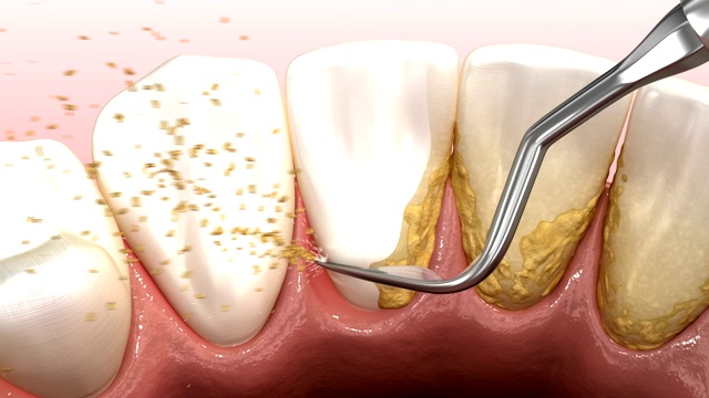 口腔卫生:超声波洁牙机，清除牙石和牙菌斑。医学上精确的人类牙齿治疗3D动画视频素材